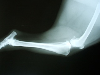 bone x ray